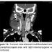 Parapharyngeal Abscess in Immunocompromised Patients